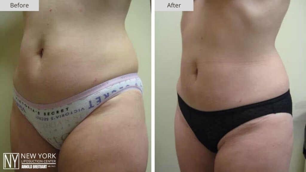 New York Hip Liposuction Before and After Patient 2