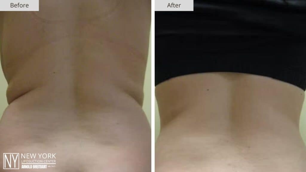 New York Love Handles Liposuction Before and After Back Patient 2