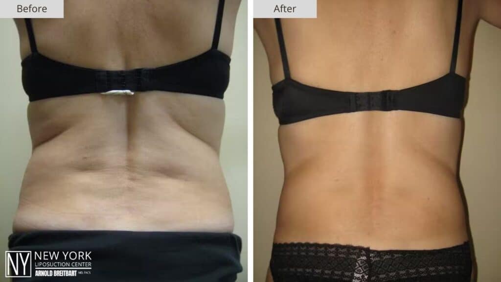 New York Love Handles Liposuction Before and After Back Patient 4