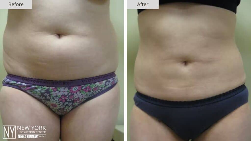 New York Love Handles Liposuction Before and After Front Patient 2