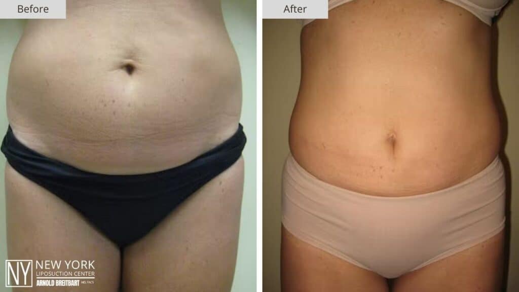 New York Love Handles Liposuction Before and After Front Patient 3