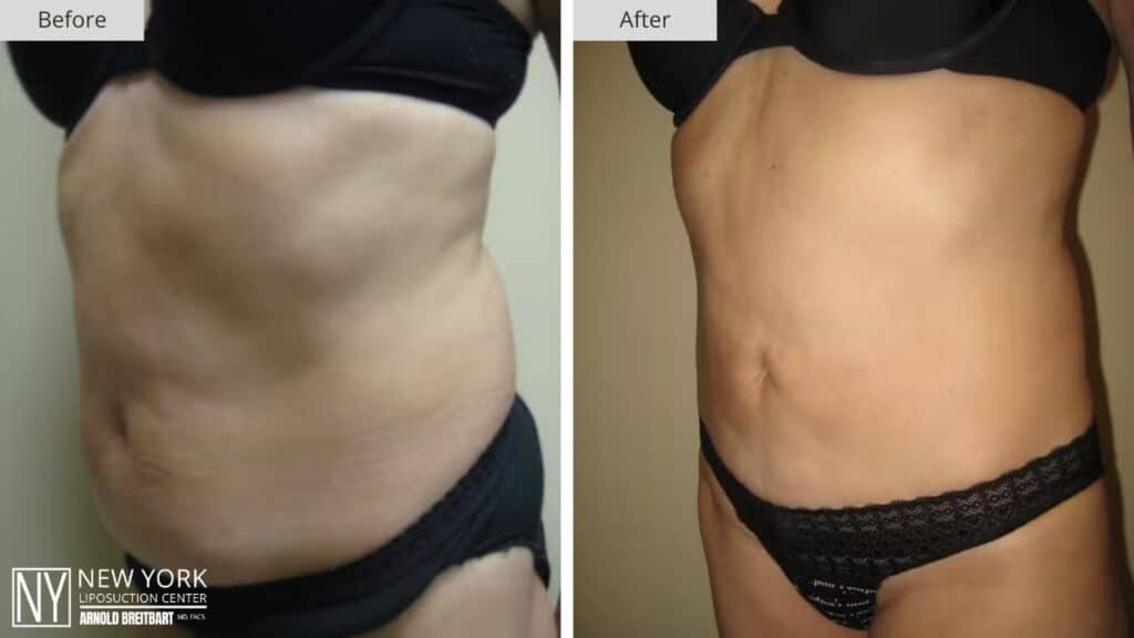 New York Love Handles Liposuction Before and After Front Patient 4