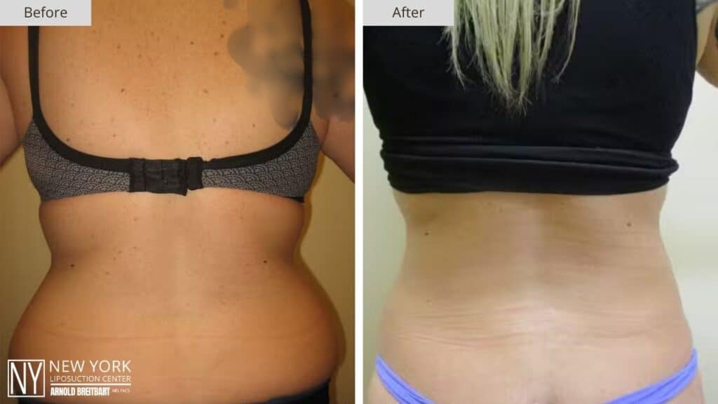 New York Love Handles Liposuction Before and After Patient 1