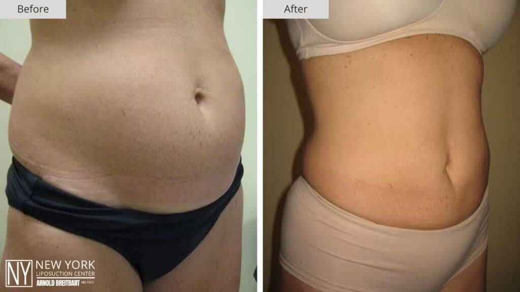 New York Love Handles Liposuction Before and After Side Patient 3