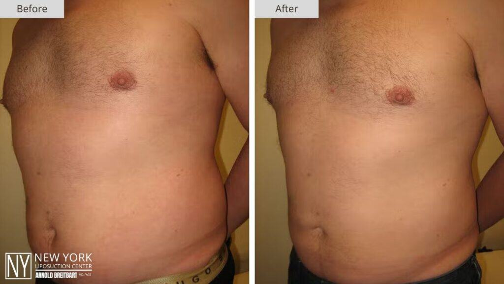 New York Male Abdomen Liposuction Before and After Patient 3 Side