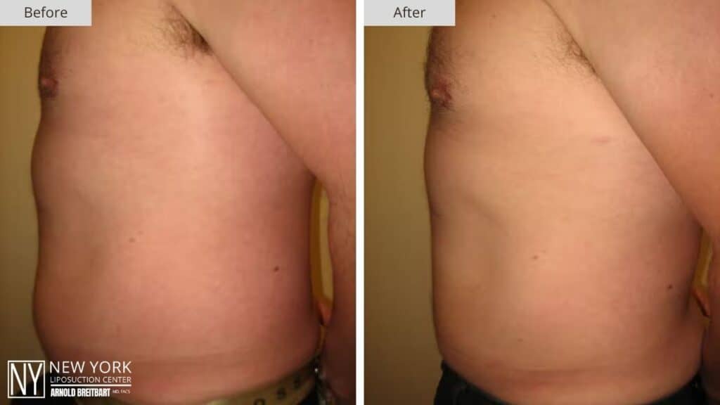 New York Male Abdomen Liposuction Before and After Patient 3 Side (2)