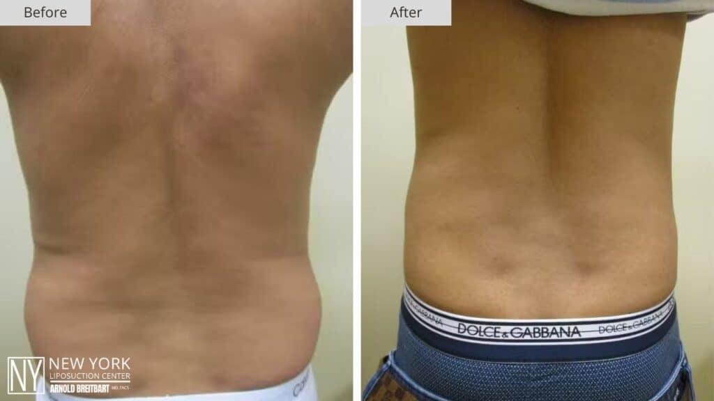 New York Male Back Liposuction Before and After Patient 1