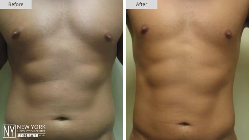 New York Male Chest Liposuction Before and After Patient 1