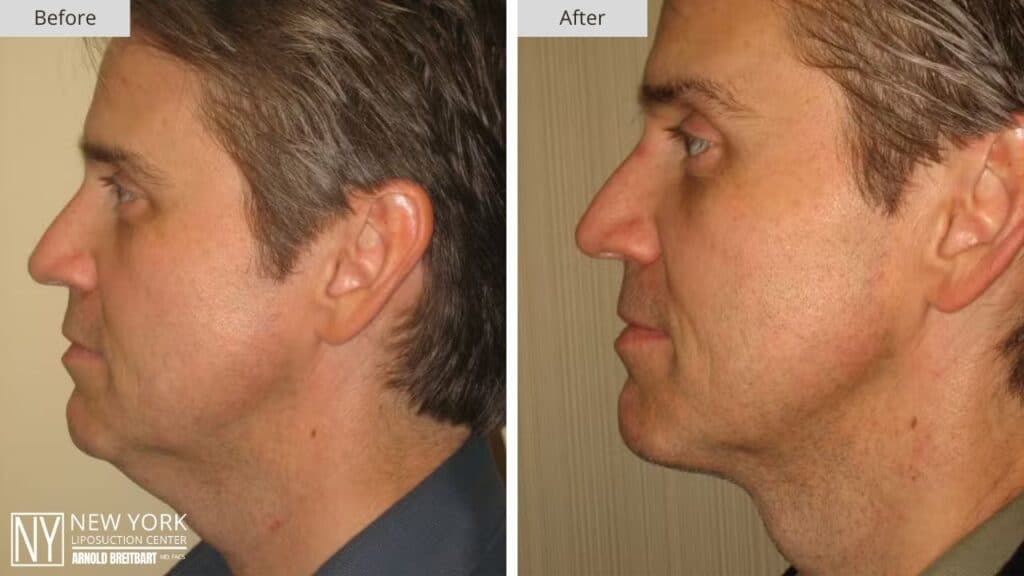 New York Male Chin Liposuction Before and After Patient 1