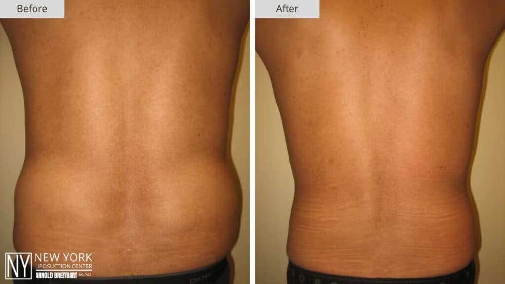 New York Male Liposuction Before and After Back Patient 2