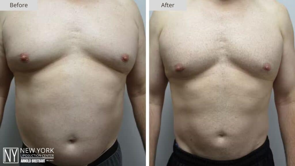 New York Male Liposuction Before and After Front Patient 1