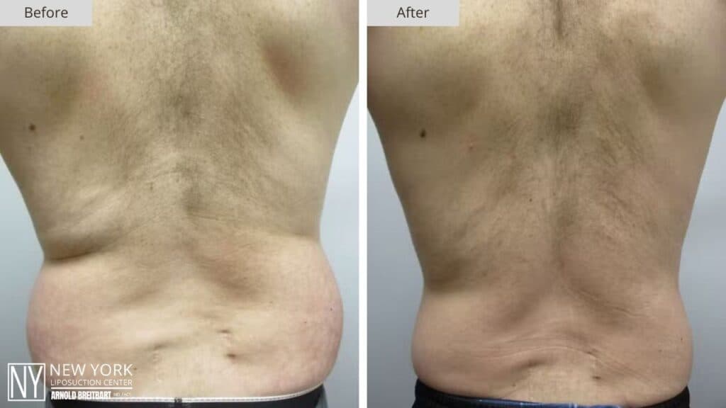 New York Male Liposuction Before and After Front Patient 1