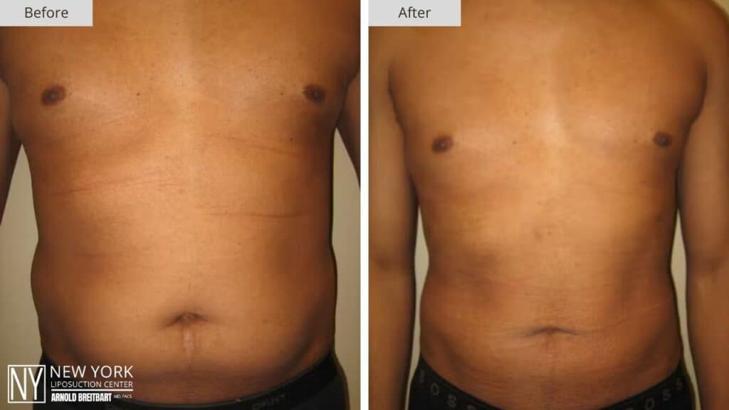 New York Male Liposuction Before and After Front Patient 2