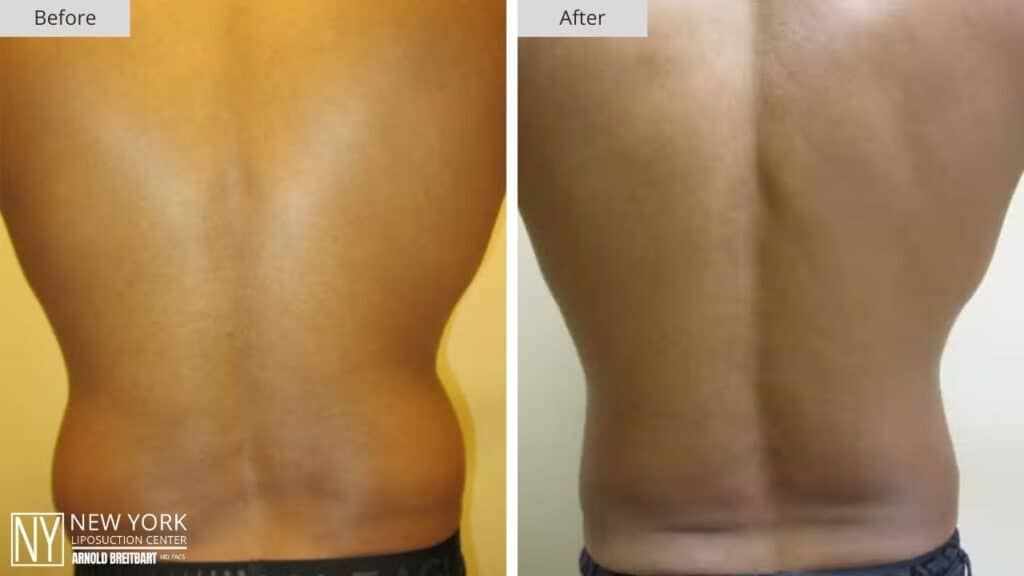 New York Male Love Handle Liposuction Before and After Patient 1