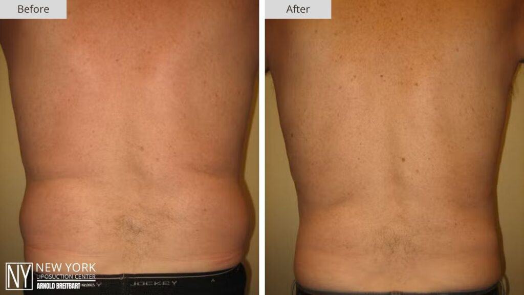 New York Male Love Handle Liposuction Before and After Patient 2