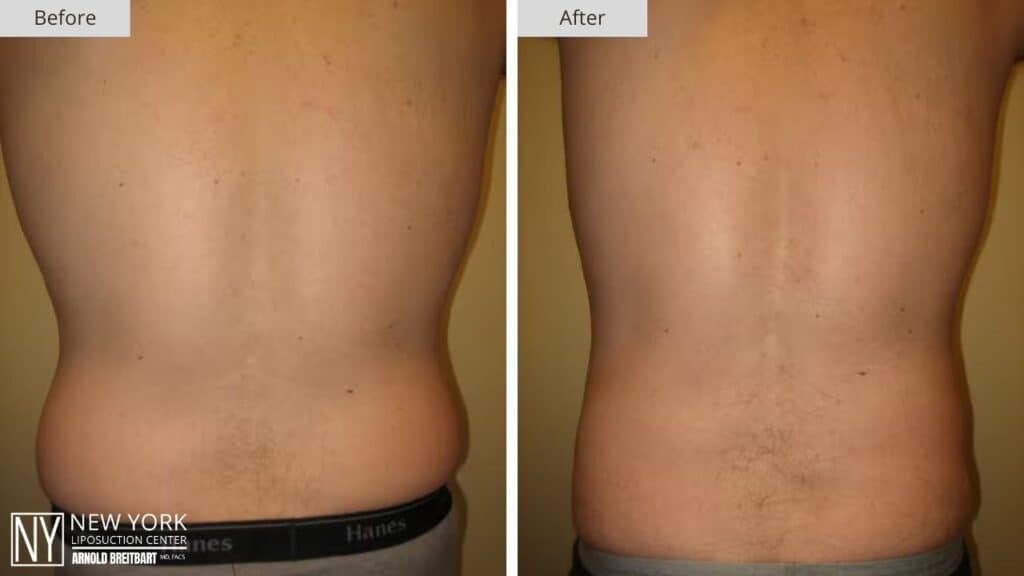 New York Male Love Handle Liposuction Before and After Patient 3