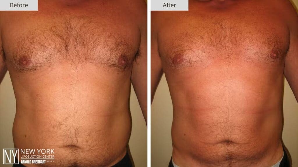 New York Male Stomach Liposuction Before and After Patient 1