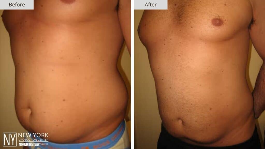 New York Male Stomach Liposuction Before and After Patient 2