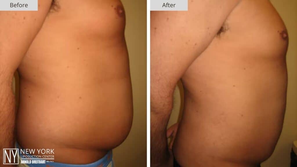 New York Male Stomach Liposuction Before and After Patient 2 Side