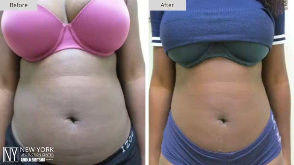 New York Stomach Liposuction Before and After Front Patient 3