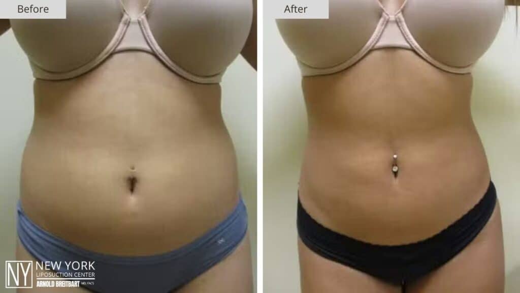 New York Stomach Liposuction Before and After Front Patient 4