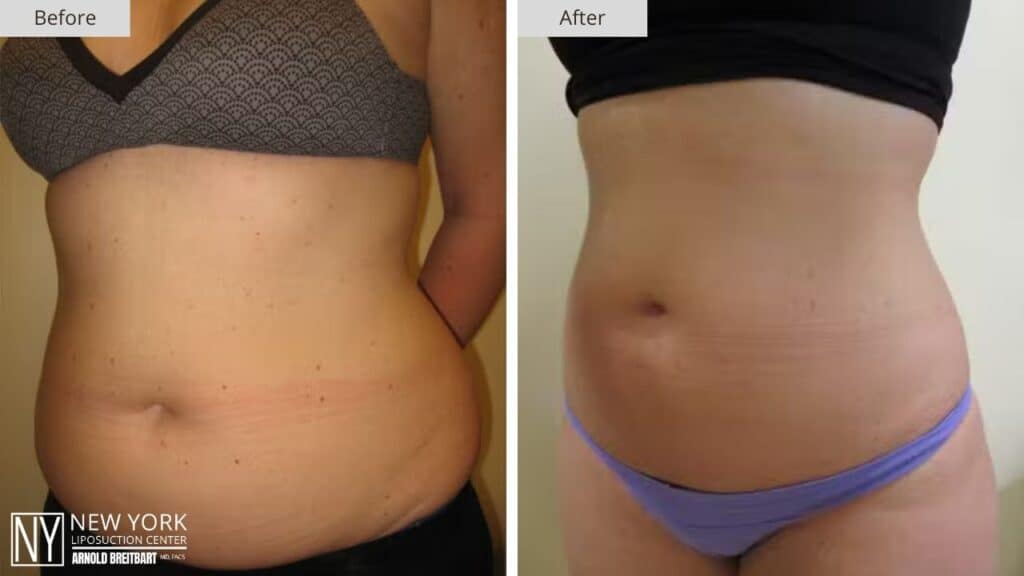 New York Stomach Liposuction Before and After Patient 1