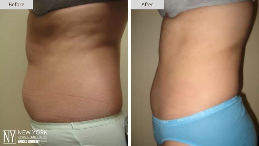 New York Stomach Liposuction Before and After Side Patient 2