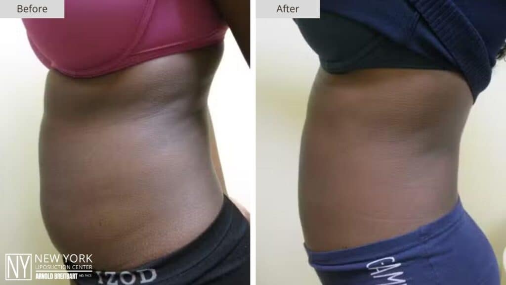 New York Stomach Liposuction Before and After Side Patient 3