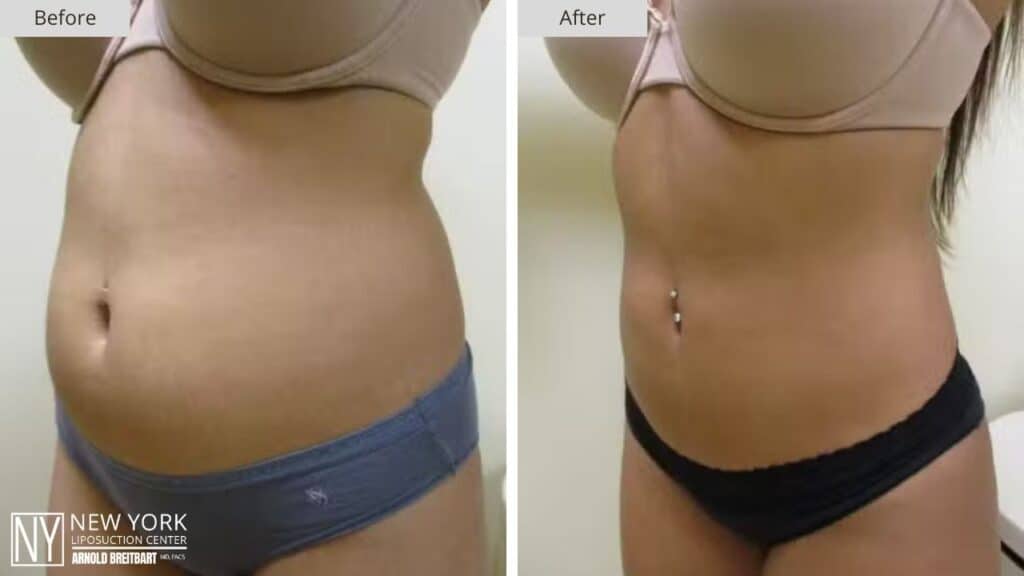 New York Stomach Liposuction Before and After Side Patient 4