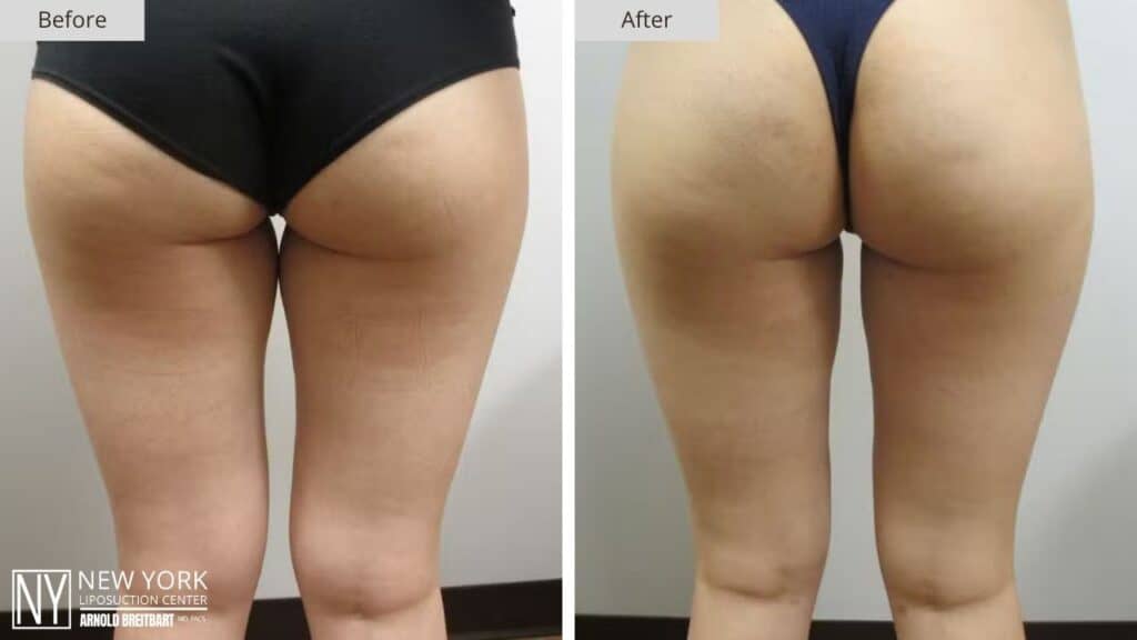 New York Thigh Liposuction Before and After Patient 1 Back