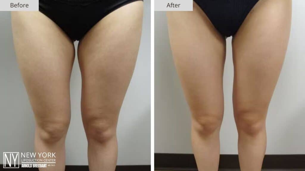 New York Thigh Liposuction Before and After Patient 1 Front