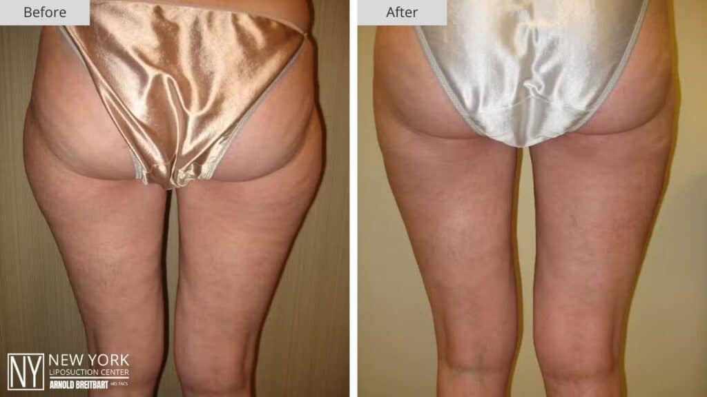 New York Thigh Liposuction Before and After Patient 2 Back