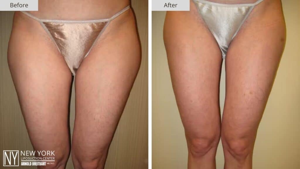 New York Thigh Liposuction Before and After Patient 2 Front