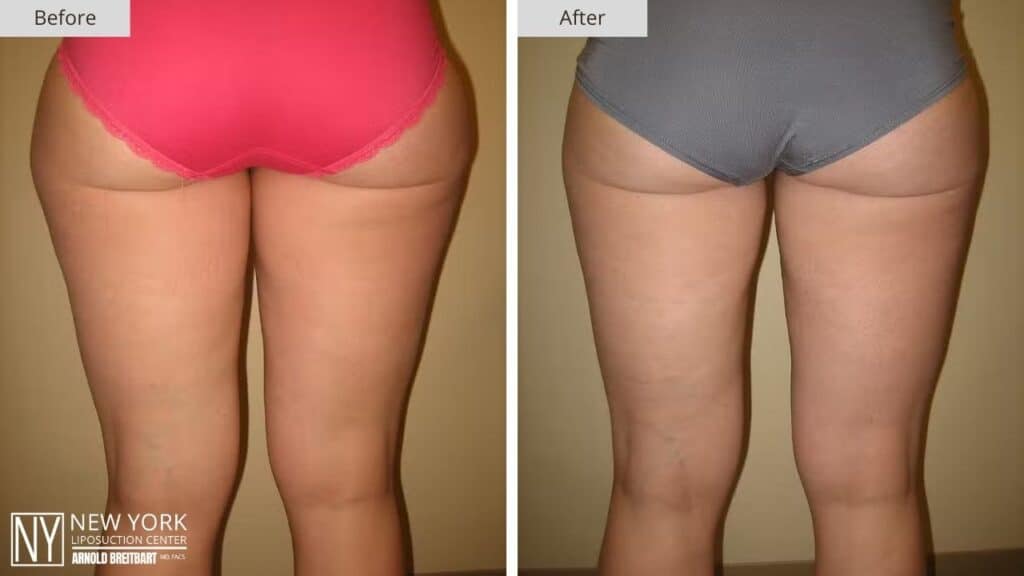 New York Thigh Liposuction Before and After Patient 3 Back