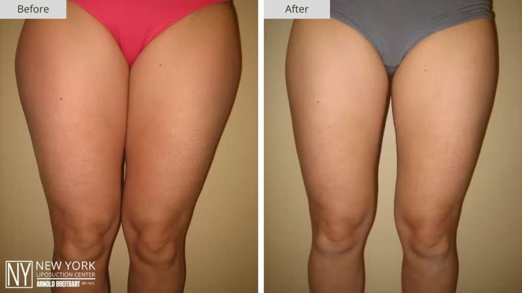 New York Thigh Liposuction Before and After Patient 3 Front