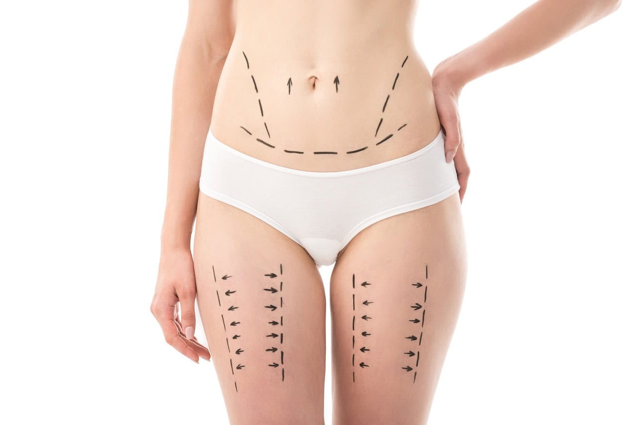 Thigh Liposuction