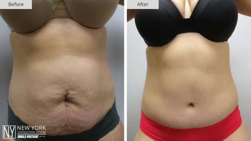 Tummy Tuck Before and After Patient 1