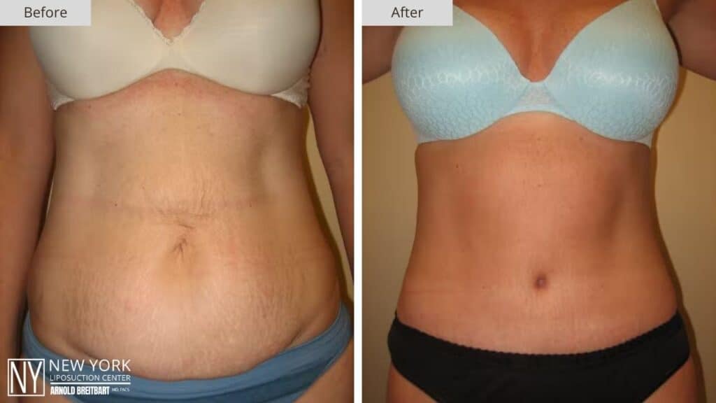 Tummy Tuck Before and After Patient 2