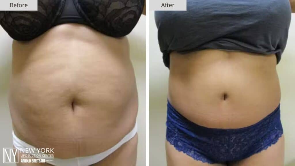 Tummy Tuck Before and After Patient 3