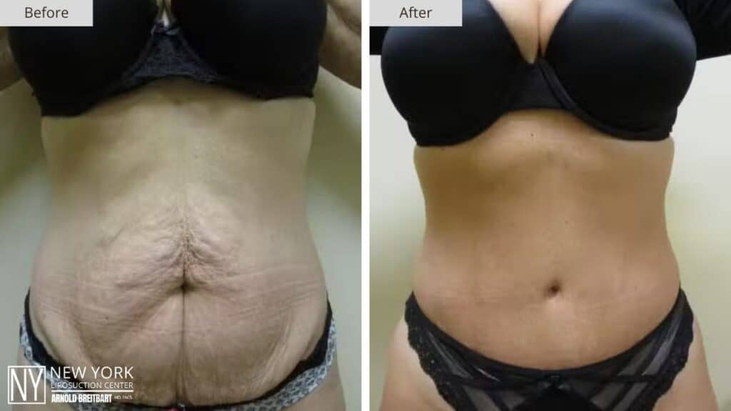 Tummy Tuck Before and After Patient 4