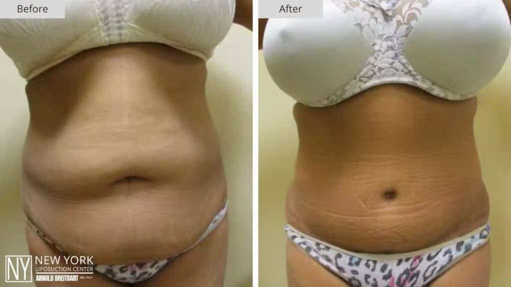 Tummy Tuck Before and After Patient 5