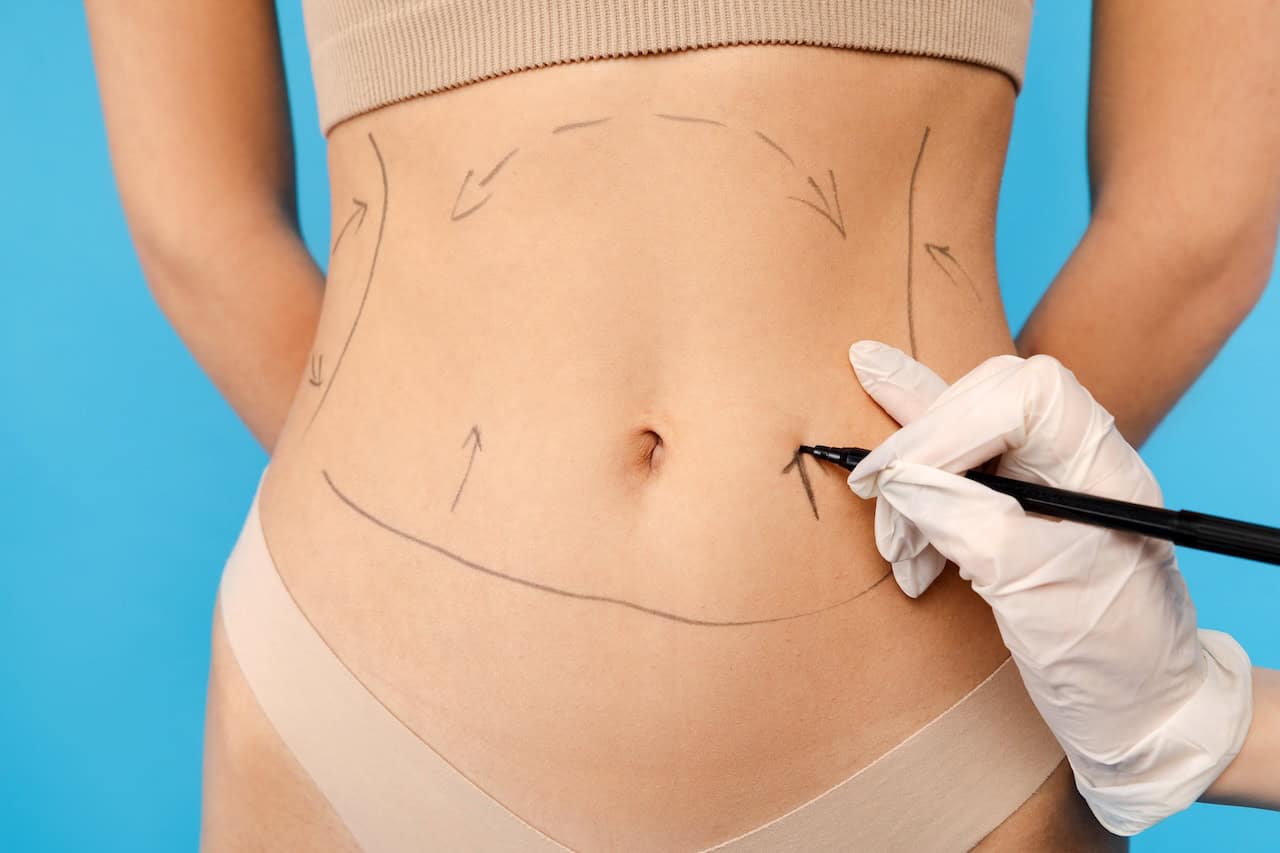 Tummy Tuck Lipo